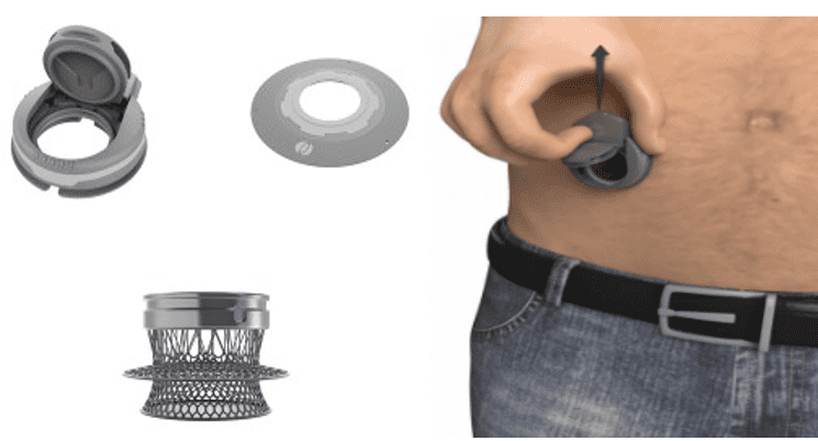 New device could 'revolutionise' lives of those living with stoma bags -  Med-Tech Innovation